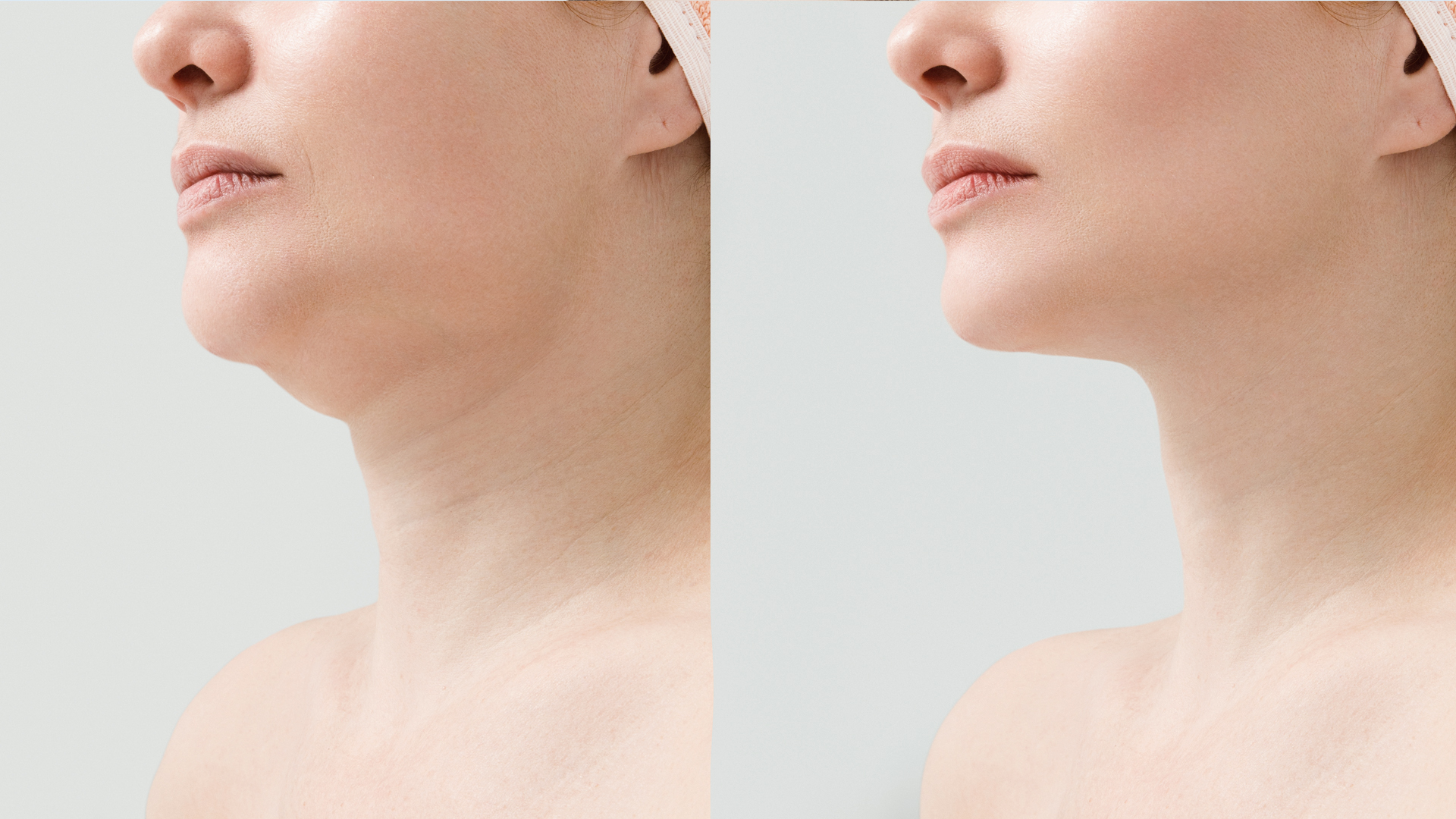 Double Chin Threading Selamat Tinggal Double Chin: Yuk, Coba Thread Lift! - Orchidée de Beauté